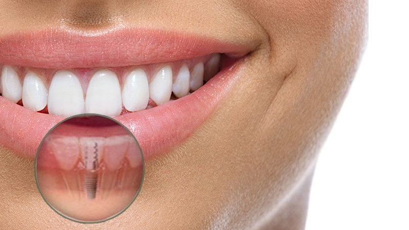 Implantes dentários 