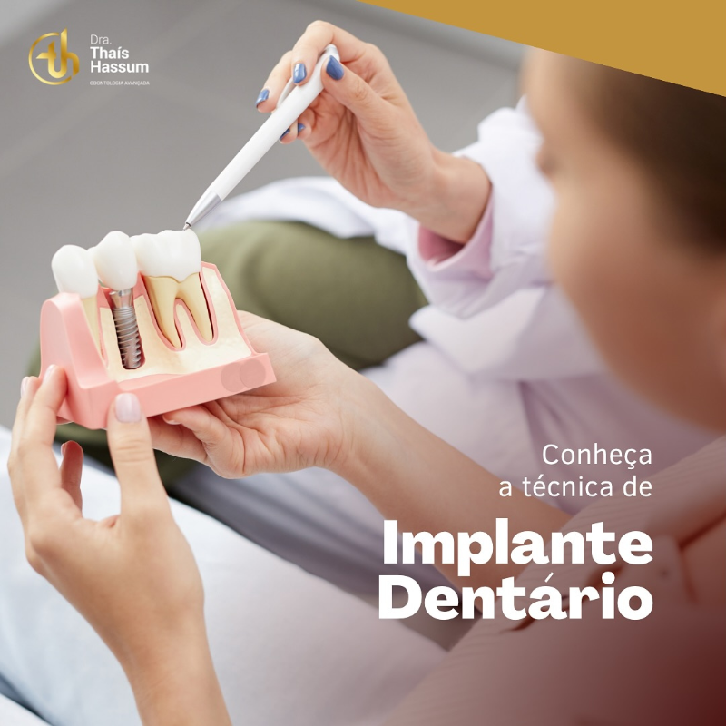 IMPLANTE