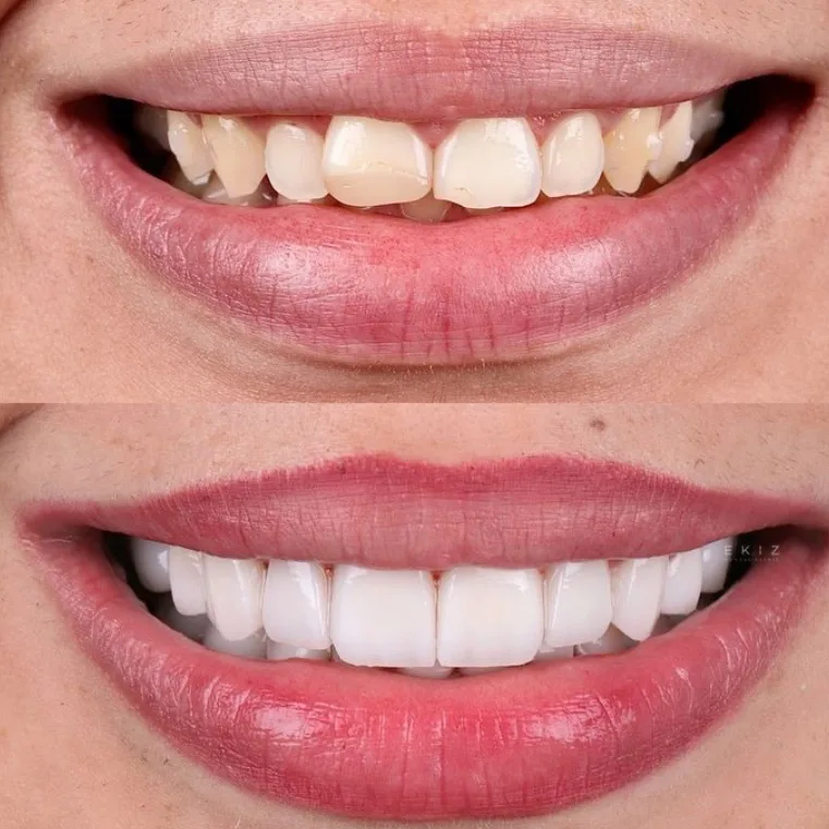 antes e depois
