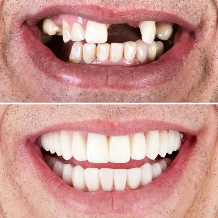 antes e depois