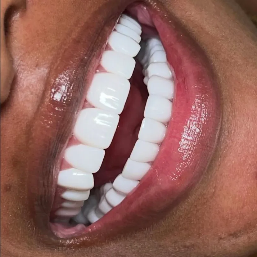 facetas